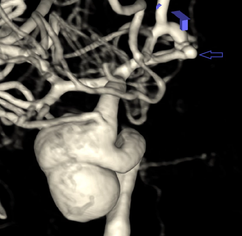 DSA 3D snímek gigantického intrakavernózního aneuryzmatu pravé karotidy. <br>
Fig. 1. 3D DSA of right giant intracavernous internal carotid artery aneurysm. Arrow 
