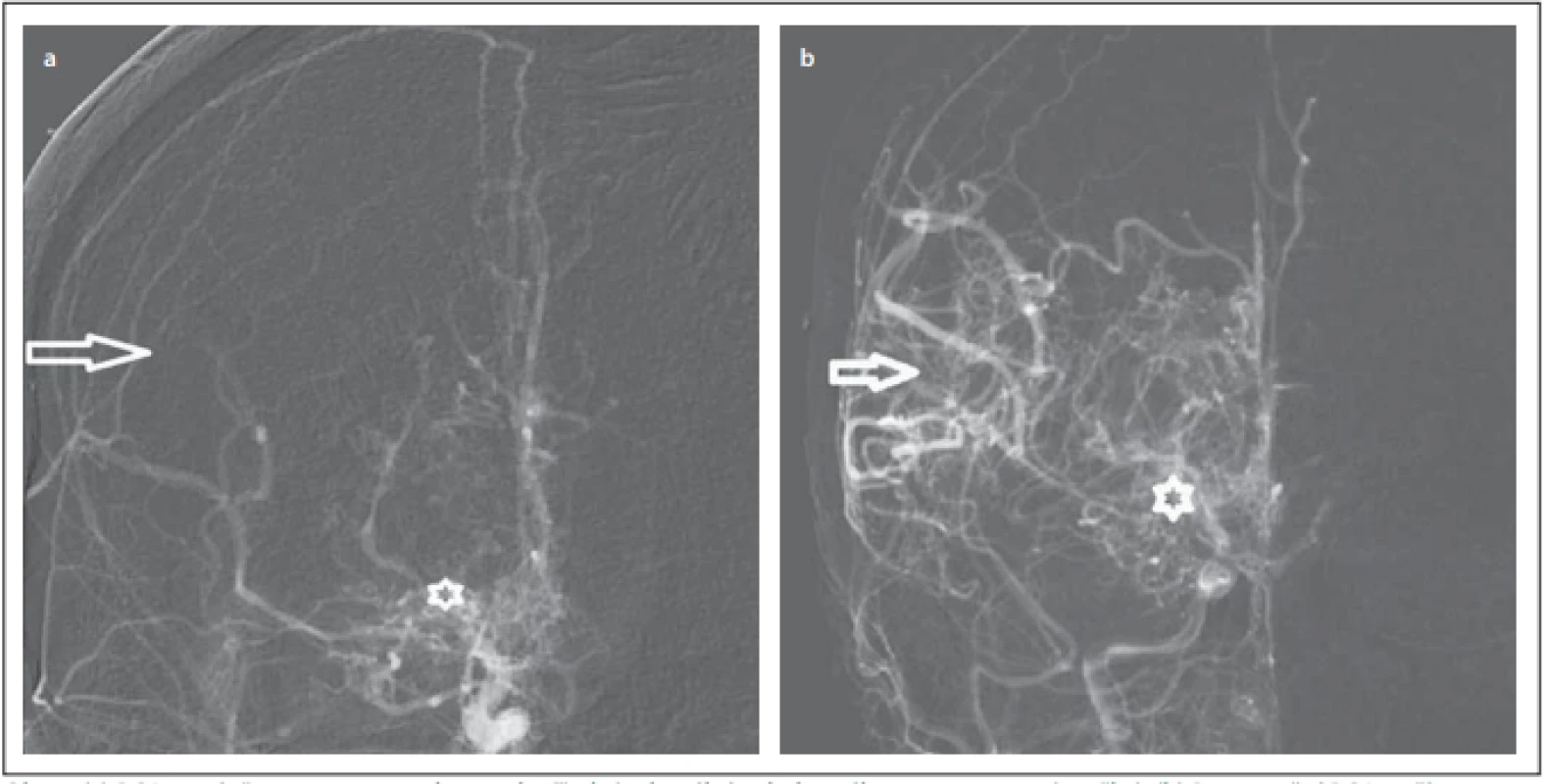 (a) DSA s uzávěrem arteria cerebri media (šipka) a bazálními kolaterálami moyamoya (značka). (b) Pooperační DSA s příznivou
revaskularizací (šipka), bazální kolaterály moyamoya jsou stále přítomny (značka).<br>
Fig. 1. (a) DSA with occlusion of the middle cerebral artery (arrow) and basal moyamoya collaterals (mark). (b) Postoperative DSA with
suffi cient revascularization (arrow), basal moyamoya collaterals are still present (mark).