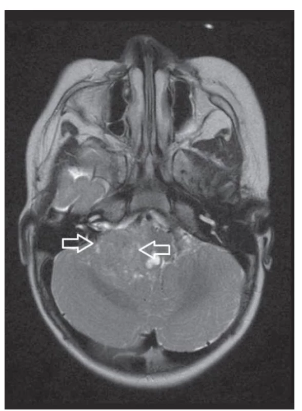 T2 vážený axiální sken 3mm, intraaxiální tumor zadní
jámy.<br>
Fig. 3. T2-weighted 3-mm axial scan, intraaxial posterior fossa
tumor.