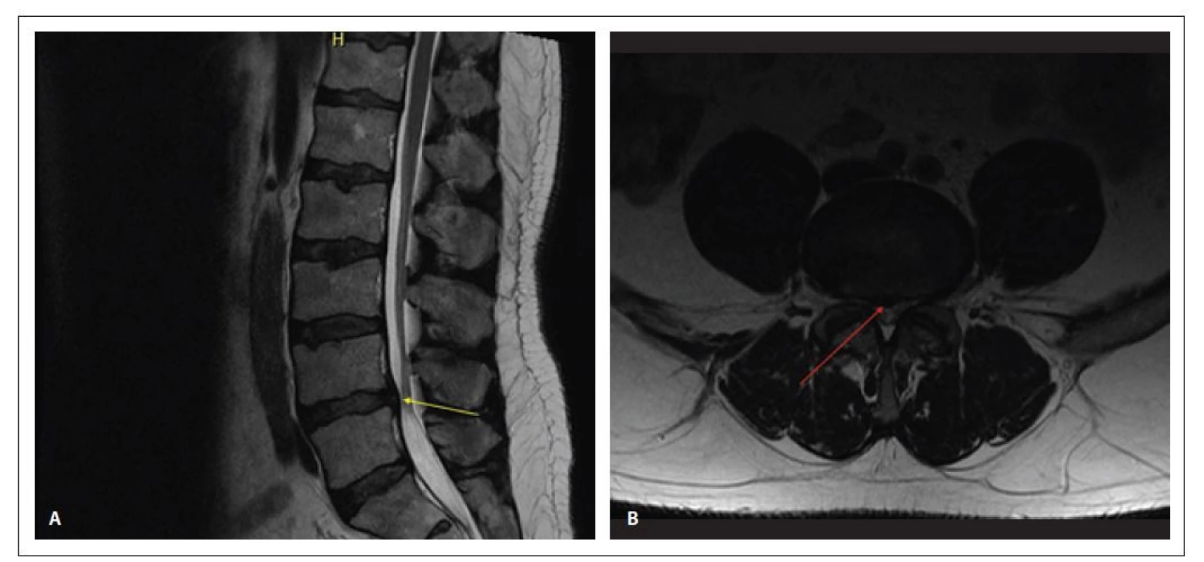 Kontrolní MR z prosince 2019 – T2 vážené obrazy v sagitální (A) a transverzální (B) rovině – došlo k postupné resorpci výhřezu
ploténky (šipka) a významné regresi stenosy páteřního kanálu ze 3 na 9 mm<br>
Fig. 2. Follow-up MRI (December 2019) – T2 weighted images in sagittal (A) and transversal (B) plane – apparent resorption of the disc
herniation and recovery from spinal stenosis from 3 to 9 mm width of the central canal.