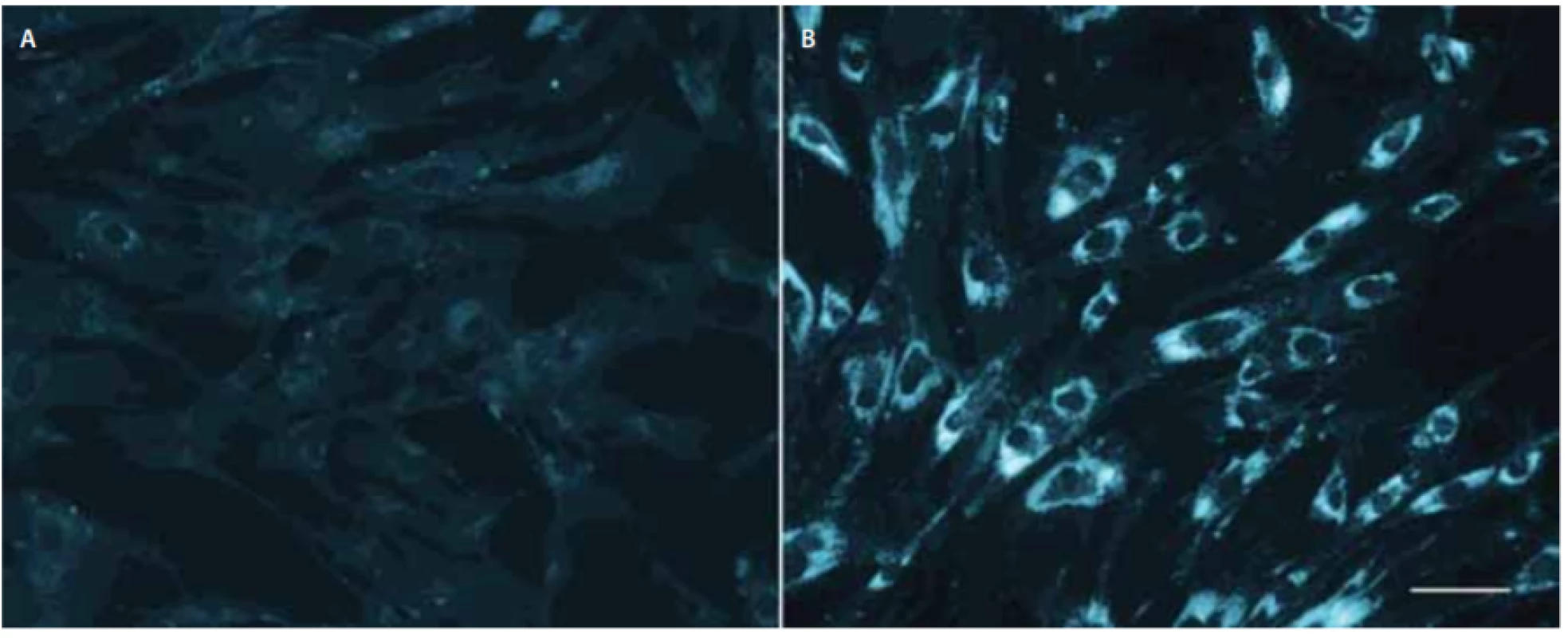 Buněčné kultury kožních fibroblastů po barvení filipinem, bez zátěže liproteinem o nízké hustotě. Levý panel (A) kontrolní fibroblasty; pravý panel (B) fibroblasty pacienta s infantilní formou Niemann-Pickovy choroby typu C1 nesoucího dvě nulové mutace<br>
v NPC1. Délka značky v pravé části odpovídá 50 μm.
Fig. 2. Filipin staining of skin fi broblast cell cultures without low-density lipoprotein-challenge. Left panel (A) control fibroblasts; right
panel (B) fi broblasts from an infantile Niemann-Pick disease type C1 patient carrying two null mutations in NPC1. Marker on the right
corresponds to 50 μm.