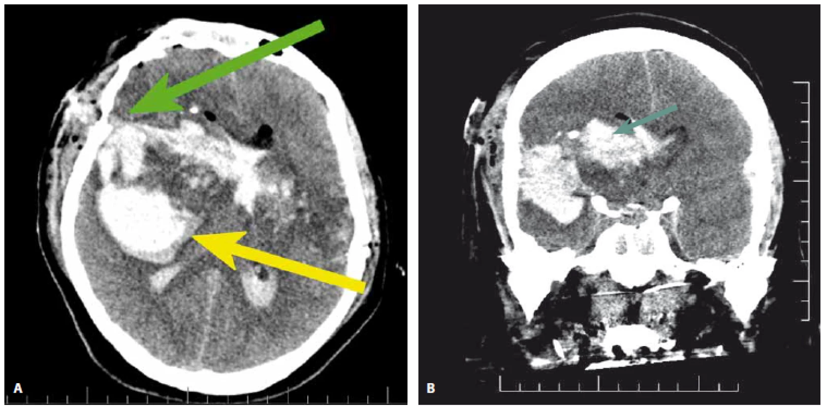 CT mozku 34letého pacienta s průstřelem hlavy. Vlevo (2A) je axiální řez. Vstřel je umístěn ve spánkové krajině vpravo (zelená
šipka). Střelný kanál proniká přes postranní komory celým mozkem. Temporo-frontálně vpravo je umístěn přidružený intracerebrální
hematom (žlutá šipka). Přesun středočárových struktur dosahuje 15 mm, patrna je také setřelá gyrifikace mozku. Na snímku vpravo
(2B) je koronární řez poraněným mozkem. Zelená šipka ukazuje na střelný kanál prostupující komorovým systémem.<br>
Fig. 2. CT scan of a 34-year-old patient after penetrating brain injury in a suicidal attempt. Left (2A): CT axial scan. The bullet entry is located
in the temporal bone (green arrow). The bullet trajectory goes through the brain perforating ventricles and the bullet exits in
the contralateral parietal bone. The frontal and temporal brain lobes are compromised by associated intracerebral hematoma (yellow
arrow). The midline shift is as high as 15 mm and the brain is swollen. Right (2B): coronal CT scan shows the trajectory of the bullet with
hemorrhage within the ventricles (green arrow).