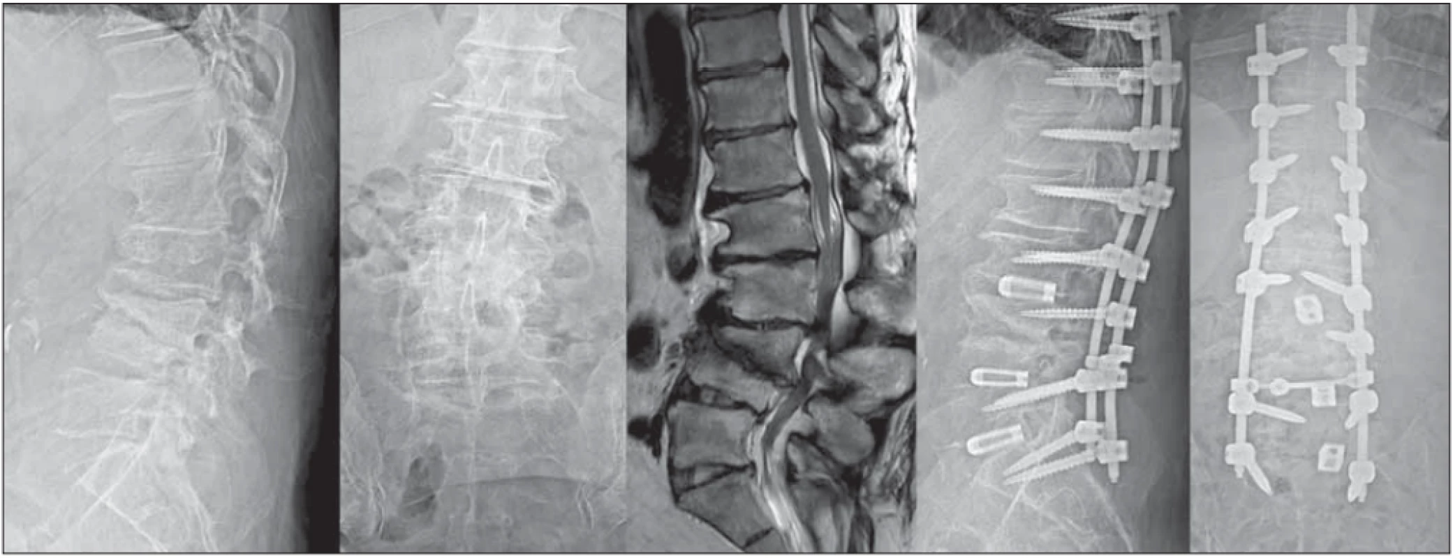  58-ročný pacient s výraznými axiálnymi aj radikulárnymi bolesťami, schopný chôdze iba na krátke vzdialenosti pre klaudikačné
ťažkosti. Grafi cký nález závažnej kyfoskoliózy (dominuje kyfóza) so stenotizáciou spinálneho kanála. Po rozsiahlom dekompresívno-
-stabilizačnom zákroku zmiernenie bolestivého syndrómu.<br>
Fig. 3. 58-year old male patient with major axial and radicular pain, able to walk only short distances due to neurogenic claudications.
Imaging fi ndings showed severe kyphoscoliosis (dominantly kyphosis) with spinal stenosis. After extensive decompression and stabilization, there was pain relief.