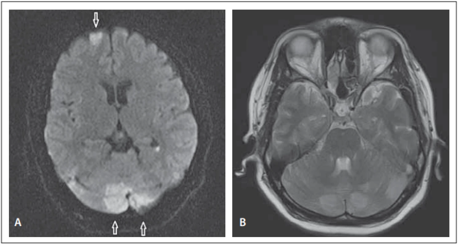 (A) Diff usion weighted MRI – focal areas of restriction in the left superior frontal
region (arrow) and in both cerebellar hemispheres (arrows). (B) MRI T2-WI sequence –
hyper-intense lesions in both cerebellar hemispheres.<br>
Obr. 1. (A) Difuzí vážená MR – ložiska restrikce nahoře frontálně vlevo (šipka) a v obou
mozečkových hemisférách (šipky). (B) T2-WI sekvence na MR – hyperintenzní léze
v obou mozečkových hemisférách.