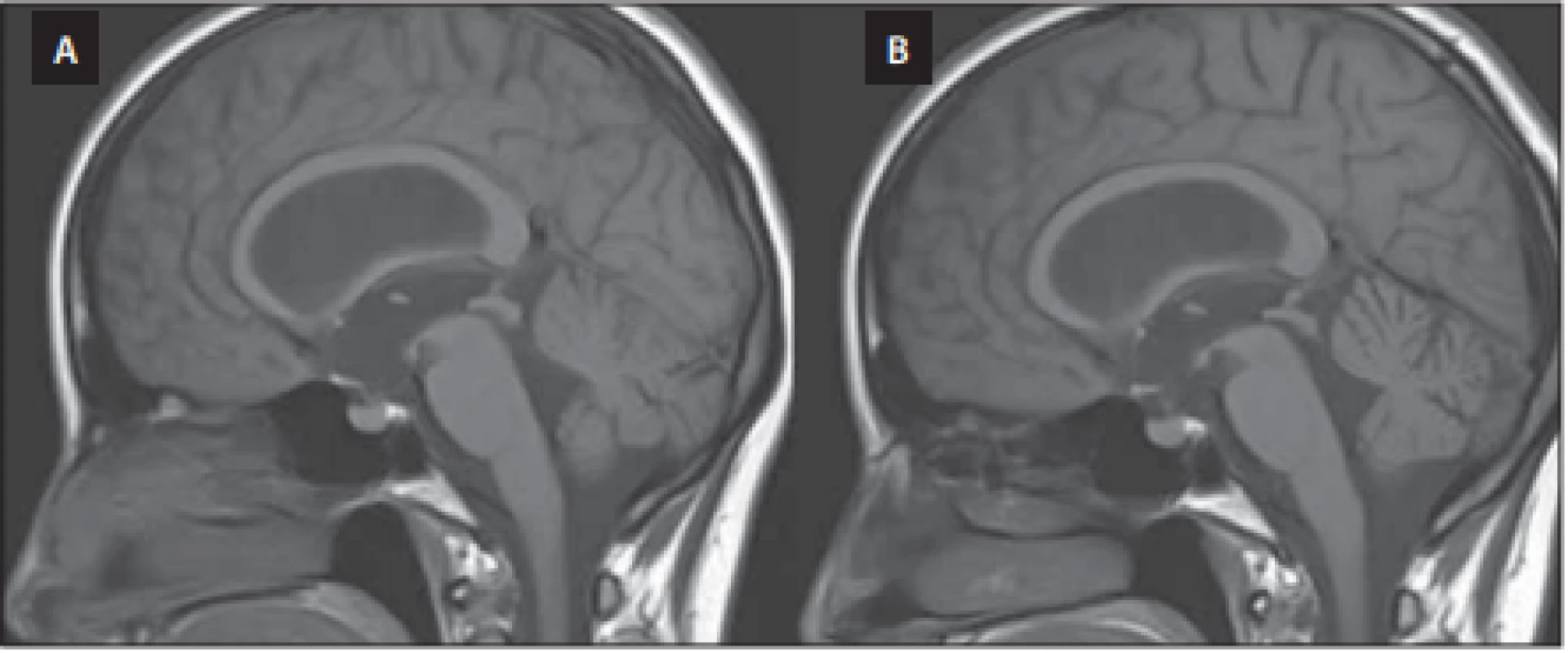  Předoperační MR mozku, T1 vážený obraz, sagitální projekce. (A) Vyjádřený 
bowing třetí komory. (B) Pooperační úprava tvaru třetí komory po úspěšné endoskopické ventrikulocisternostomii.<br>
Fig. 3. Preoperative brain MRI, T1-WI, sagittal projection. (A) Bowing of the third ventricle. (B) Postoperative correction of the third ventricle morphology after successful endoscopic ventriculocisternostomy. 