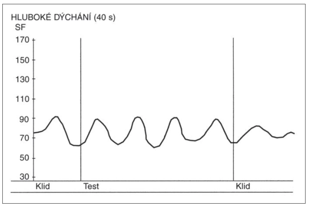Změny srdeční frekvence (SF) ve zkoušce hlubokého dýchání u zdravé osoby.
Nad osou x – křivka zobrazující změny srdeční frekvence ve zkoušce hlubokého dýchání.
Zřetelná respirační sinusová arytmie. Osa y – hodnoty srdeční tepové frekvence za minutu.<br>
Fig. 1. Heart rate (SF) changes during the deep breathing test in a healthy person.
Above the x-axis – curve depicting heart rate changes during the deep breathing test.
Marked respiratory sinus arrhythmia. Y-axis – heart rate (beats per minute)