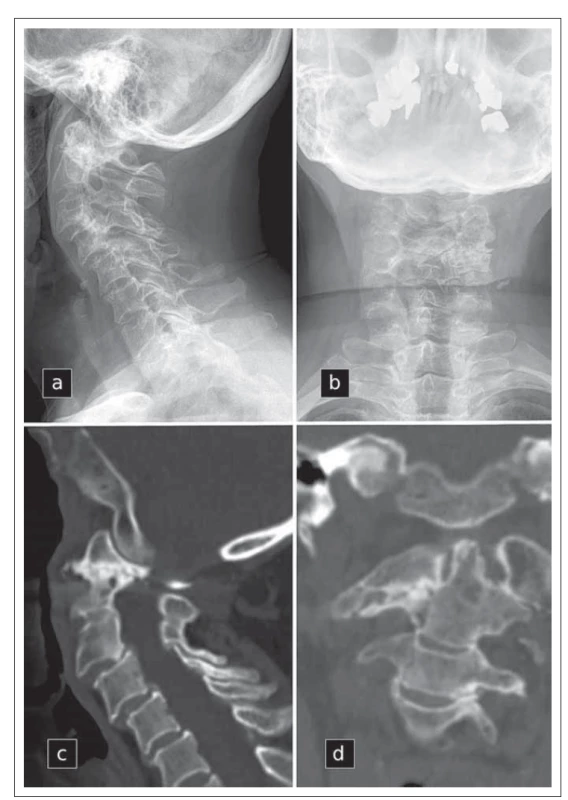 Předoperační rentgenogramy krční páteře (a, b) a předoperační zobrazení CT
(c, d), které dokumentuje revmatoidní destrukci pravostranného laterálního atlanto-axiálního kloubu.<br>
Fig. 1. Preoperative cervical spine radiographs (a, b) and preoperative CT scans (c, d)
depicting rheumatoid destruction of the right lateral atlanto-axial joint.