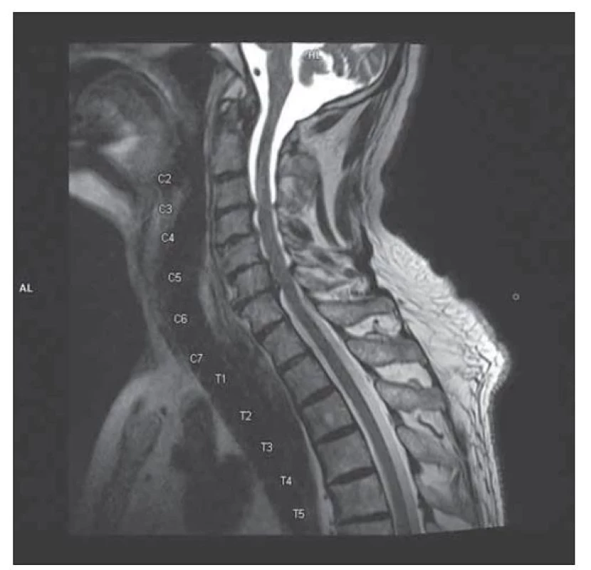 MR krční páteře, T2 vážený obraz, sagitální řez: stenóza
krční páteře C3–7.<br>
Fig. 2. MRI of cervical spine, T2 weighted image, sagittal plane:
cervical spinal stenosis C3–7.